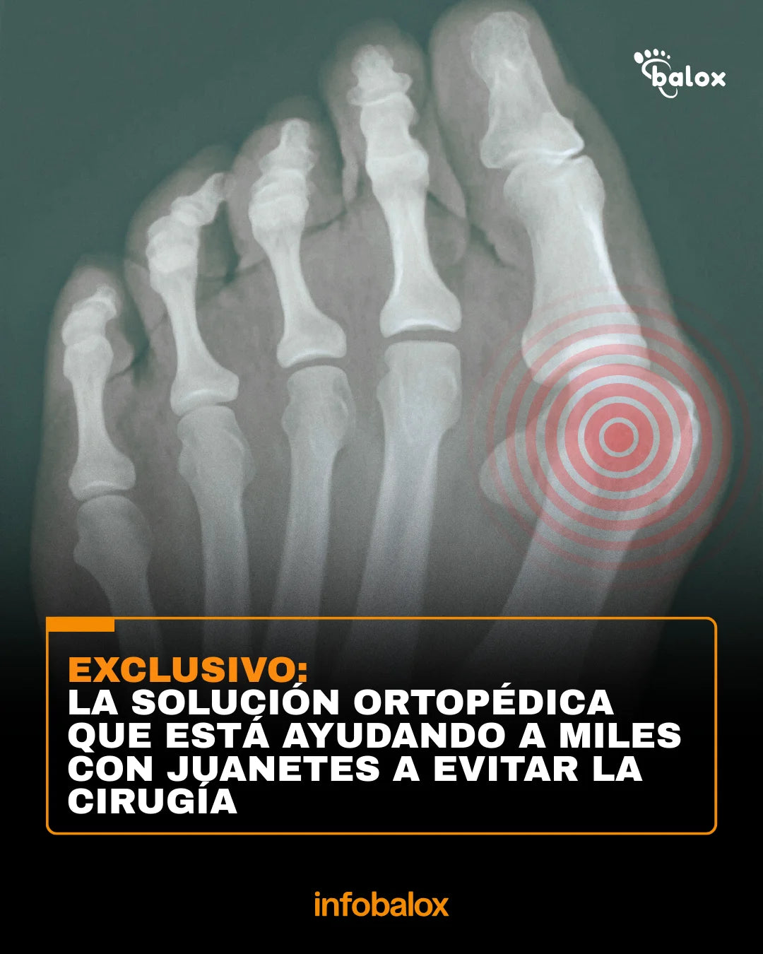 PACK 2X1 JUANET FLEX®: SISTEMA DE ALINEACIÓN ORTOPÉDICA